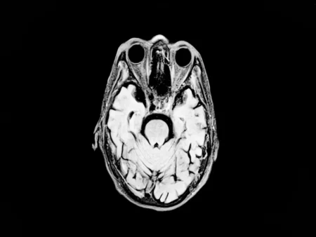 Une avancée majeur pour la maladie d'Alzheimer : des chercheurs japonais identifient la graine à l'origine des plaques toxiques