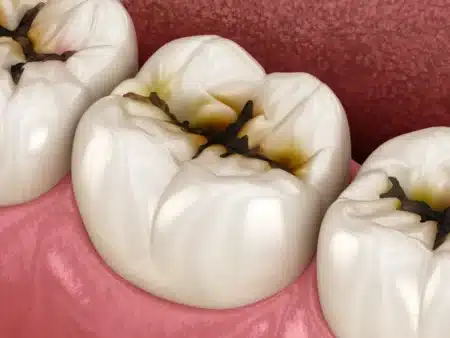 Adieu la roulette du dentiste : des chercheurs ont trouvé comment réparer une carie sans forer, et ça prend moins de 5 minutes