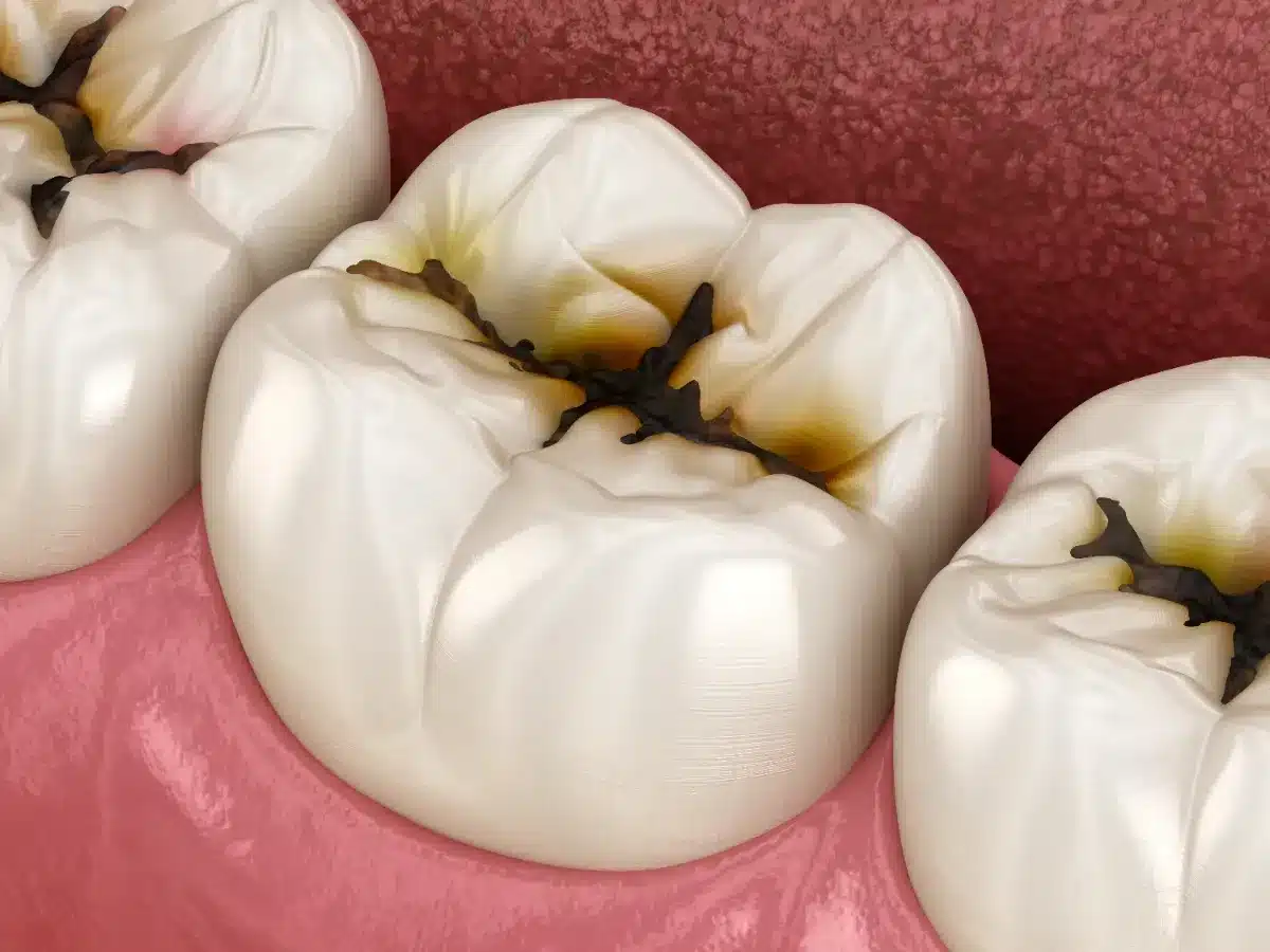 Adieu la roulette du dentiste : des chercheurs ont trouvé comment réparer une carie sans forer, et ça prend moins de 5 minutes